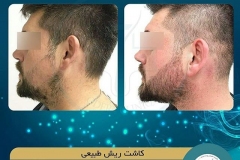 beards-and-mustaches-transplantation1