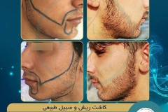 beards-and-mustaches-transplantation11