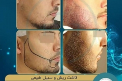 beards-and-mustaches-transplantation12