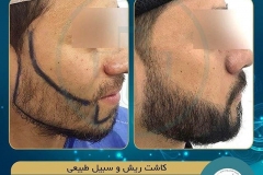 beards-and-mustaches-transplantation15