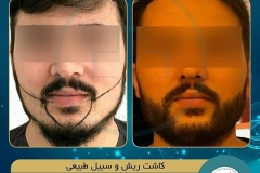 beards-and-mustaches-transplantation16