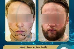 beards-and-mustaches-transplantation17
