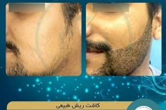 beards-and-mustaches-transplantation2