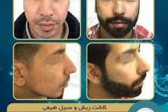 beards-and-mustaches-transplantation4