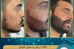 beards-and-mustaches-transplantation6