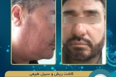beards-and-mustaches-transplantation8