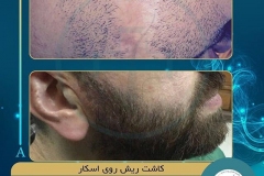 beards-and-mustaches-transplantation9