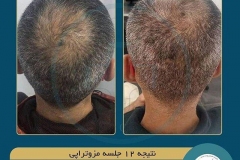 hair-mesotherapy