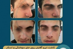 eyebrow-transplantation-men