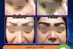 eyebrow-transplantation-women10