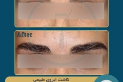 eyebrow-transplantation-women11