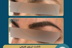 eyebrow-transplantation-women12