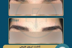 eyebrow-transplantation-women13