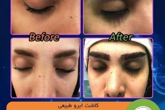 eyebrow-transplantation-women15