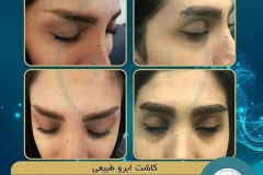 eyebrow-transplantation-women16