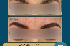 eyebrow-transplantation-women17