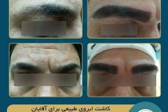 eyebrow-transplantation-women18