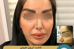 eyebrow-transplantation-women19