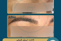 eyebrow-transplantation-women20