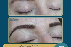 eyebrow-transplantation-women5