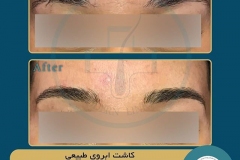 eyebrow-transplantation-women6