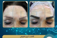 eyebrow-transplantation-women9