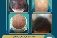 hair-transplantation12