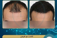 hair-transplantation13