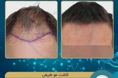 hair-transplantation23
