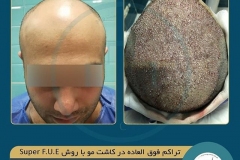 hair-transplantation30
