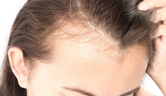 علت ریزش مو در زنان