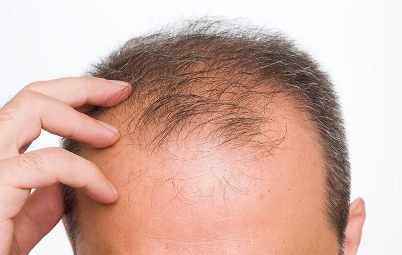 ارتباط بین پوست سر و ریزش مو
