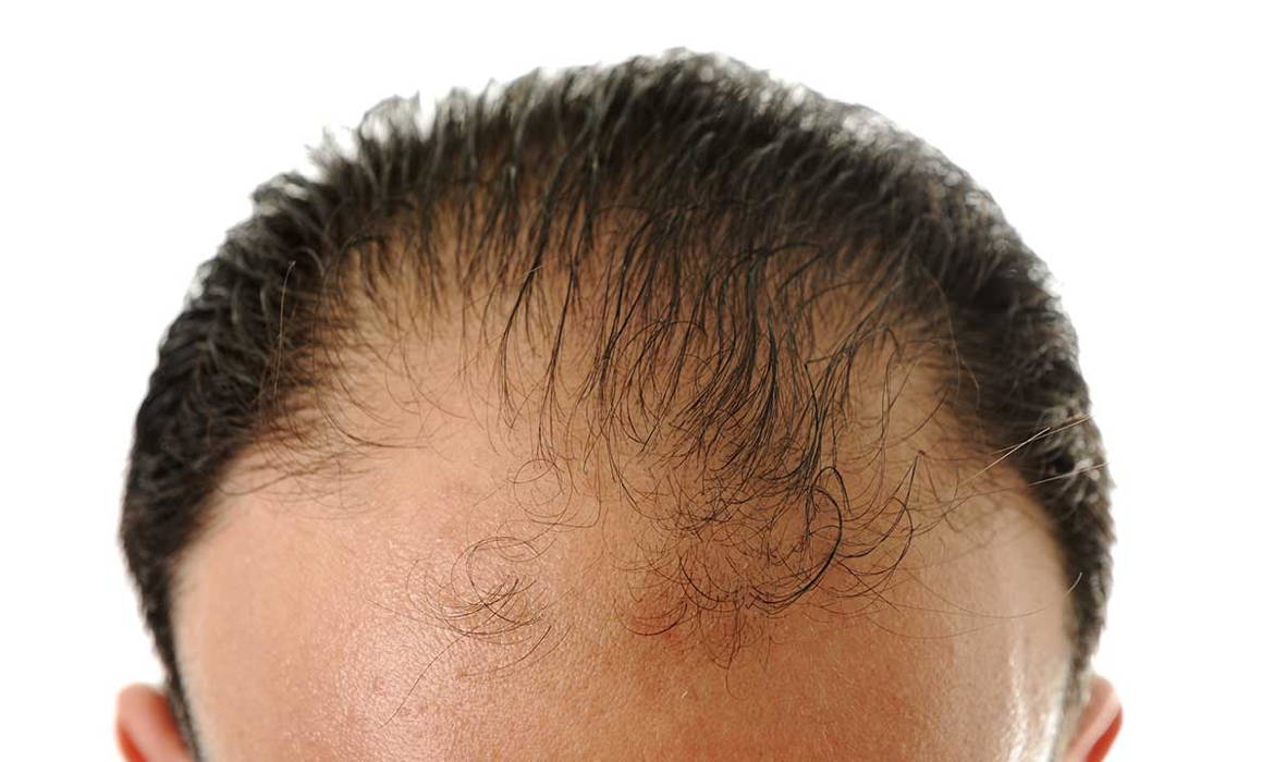 درمان ریزش مو در بیماری لوپوس