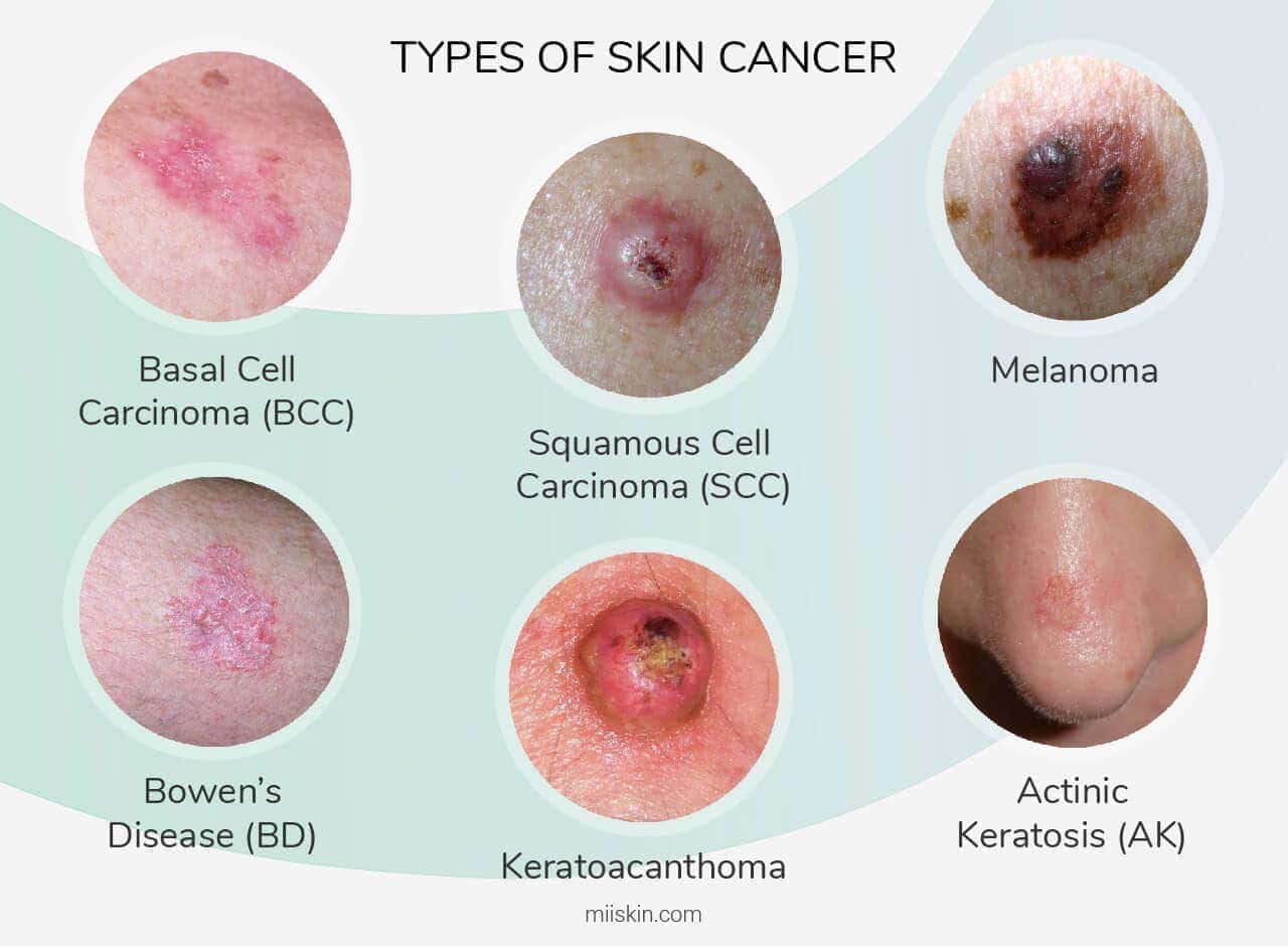 پیشگیری از سرطان پوست