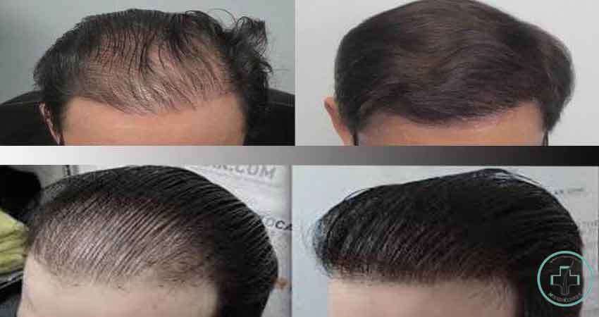 نتیجه کاشت مو در سه ماه اول، دوم و سوم‌