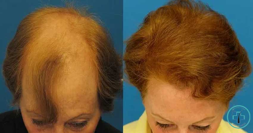 کاشت مو برای بیماران آلوپسی