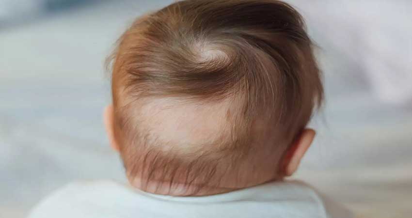 انواع ریزش مو در کودکان