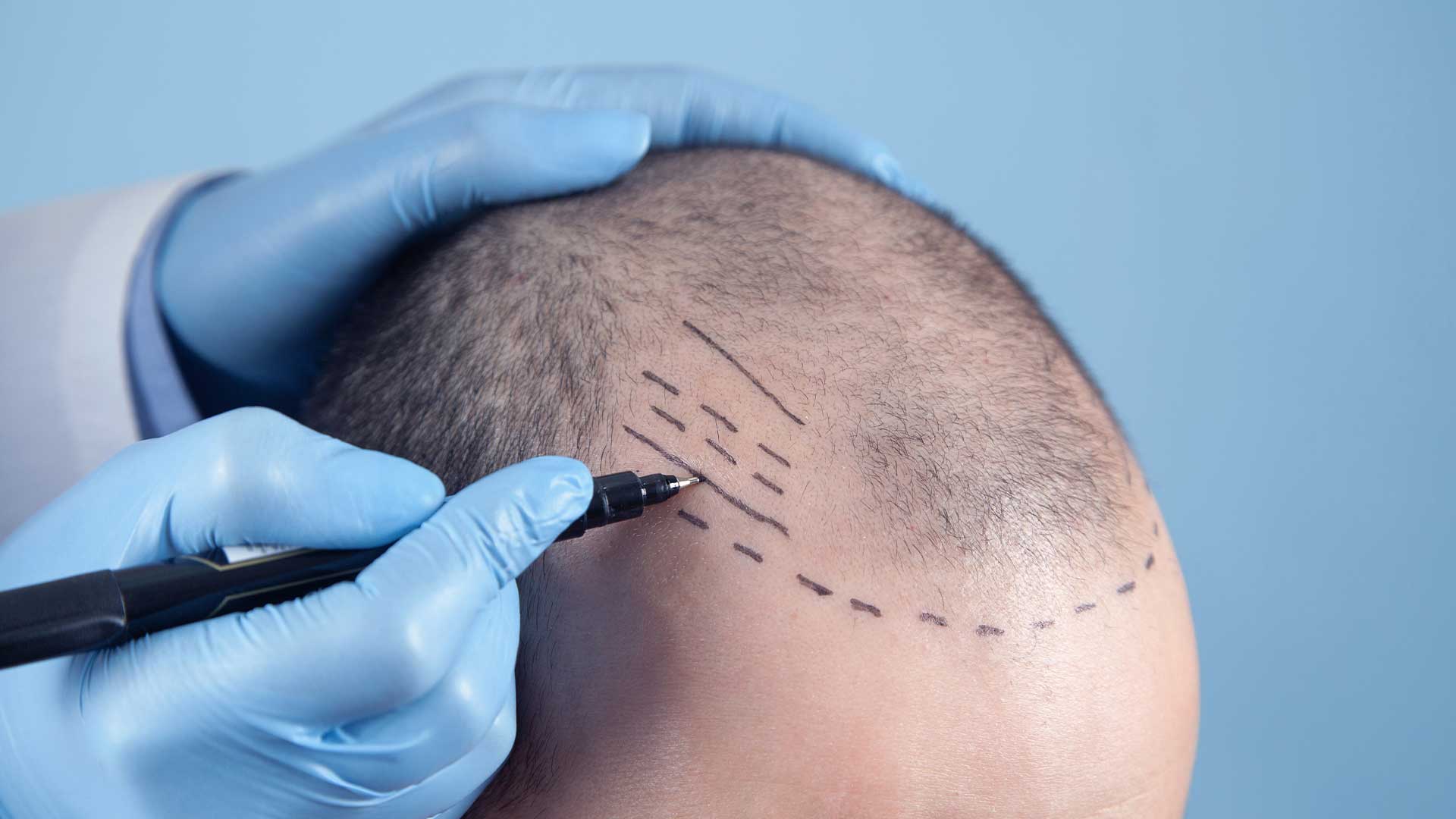 آیا جدیدترین روش‌های کاشت مو نتایج طبیعی‌تری دارند؟