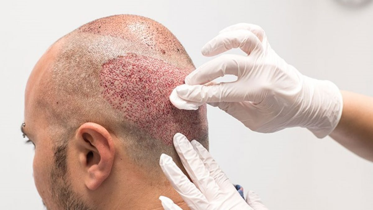 برای کاهش درد های ناشی از کاشت مو چه اقداماتی می توان انجام داد؟