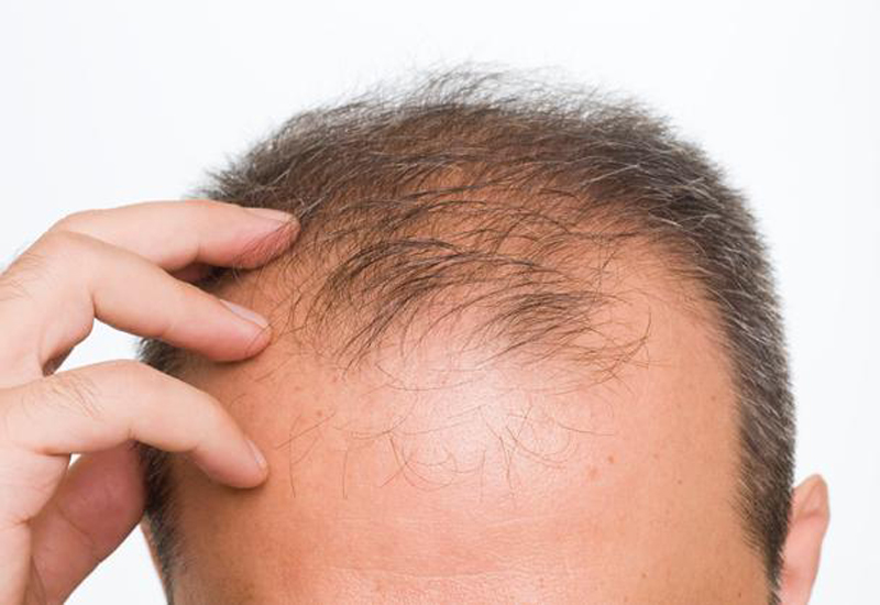 کاشت مو و روش‌های پیشگیری از ریزش مجدد