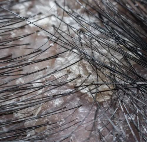 شایع ترین دلایل شوره مو پس از کاشت