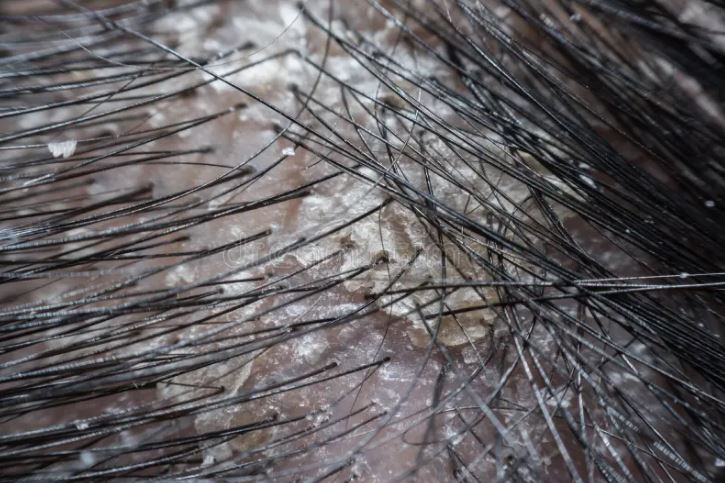 شایع ترین دلایل شوره مو پس از کاشت